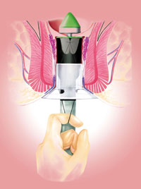 Longo Operation