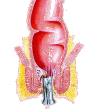 Gummibandligatur